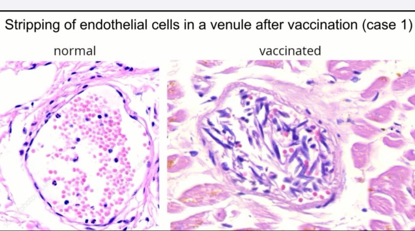 WATCH: COVID Vaccines ARE Killing People Autopsies Prove | Prof. Arne Burkhardt & Prof. Sucharit Bhakdi